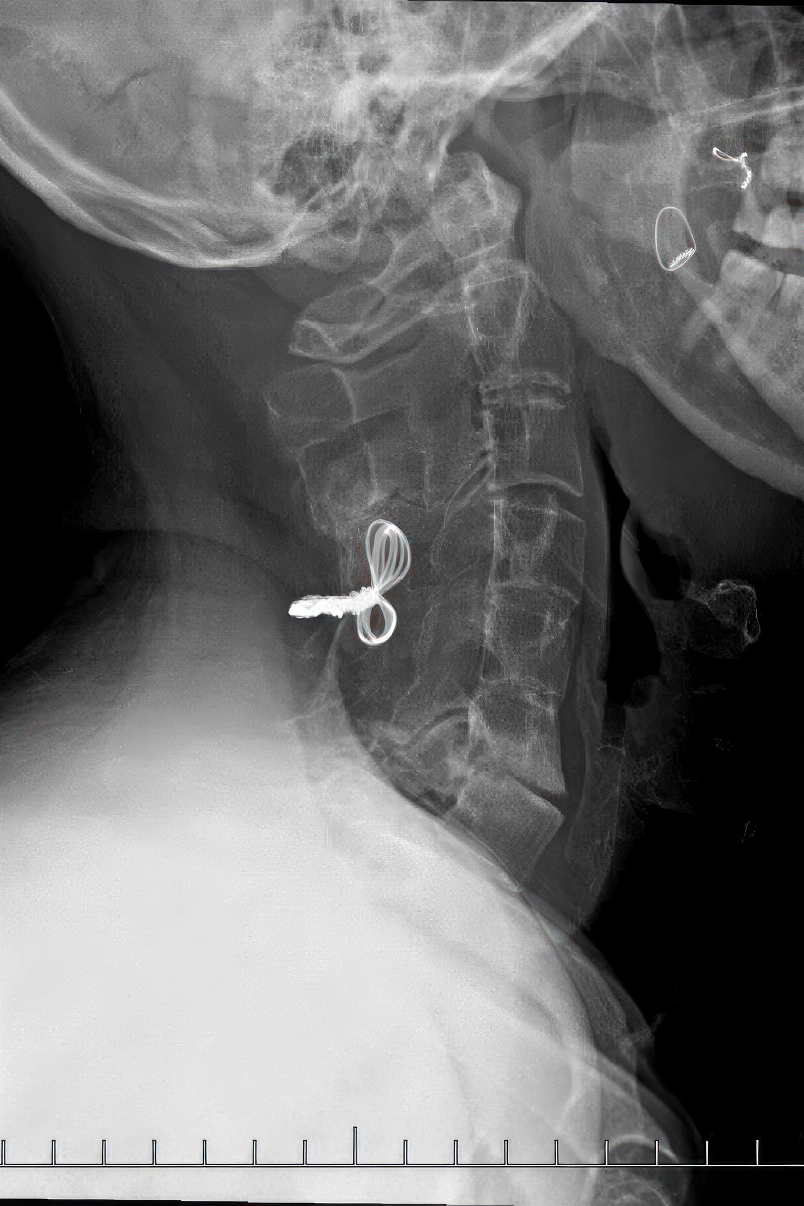 Cervical spine X-ray